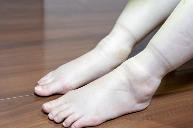 足首に浮腫みの後がのこっている状態
