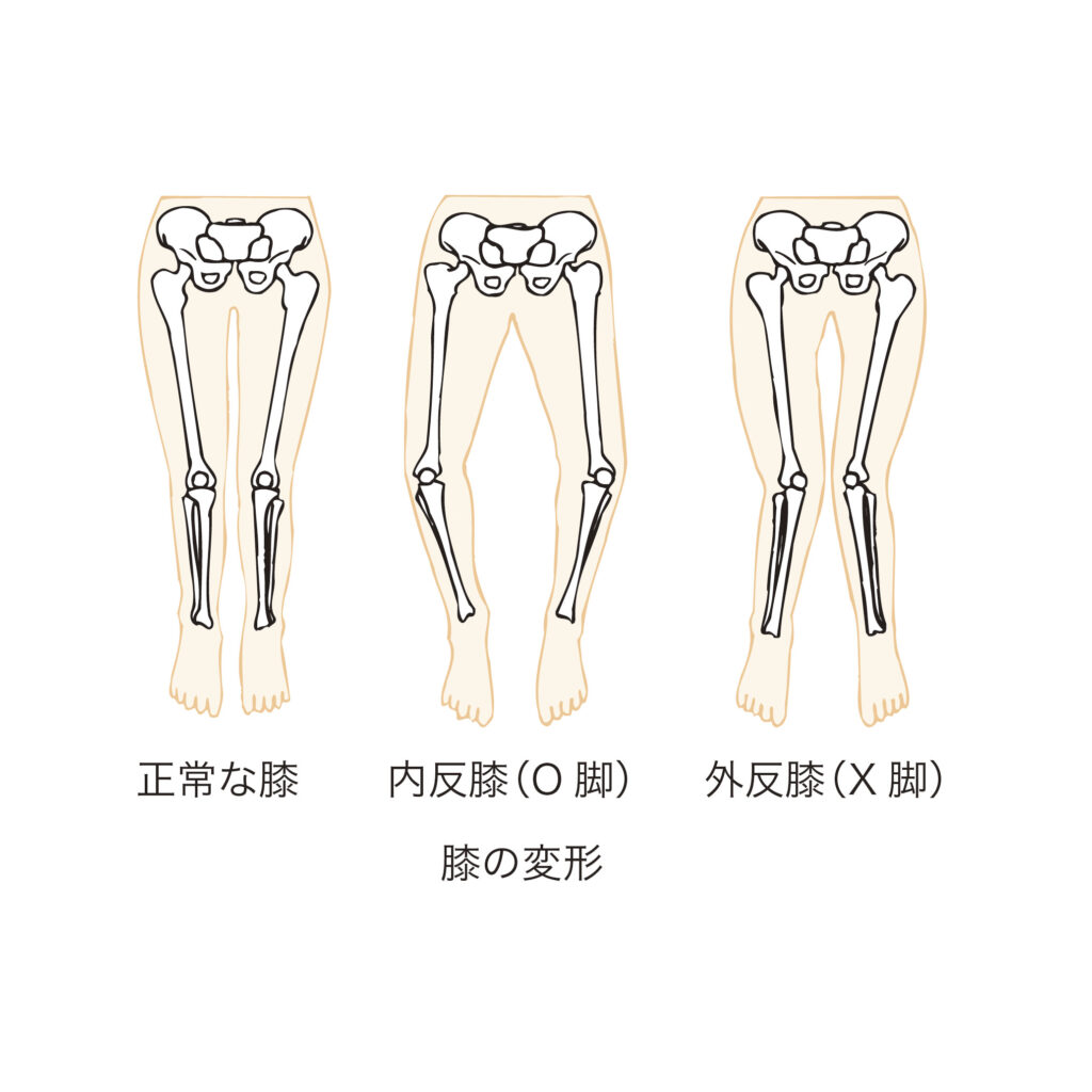 変形性膝関節症説明
